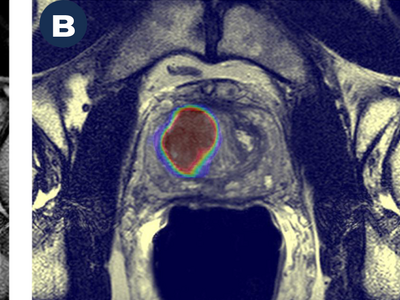 A Magnetic Resonance Image (MRI) on the left (A) shows a suspicious cancer lesion (dark mass marked by arrows). A deep learning-based AI algorithm helps further define this lesion as prostate cancer (B). The lesion in B is displayed as a large red mass, outlined in blue and green. The lesion in B is much larger than the one shown in A, indicating AI helped to better define the extent of the cancer than MRI alone. 