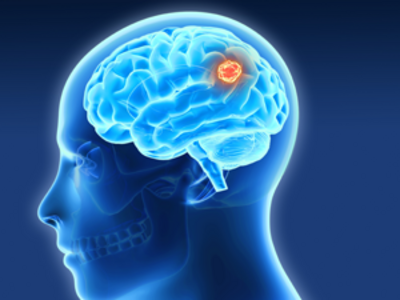 Head in profile with imaging of brain with a tumor in it. 