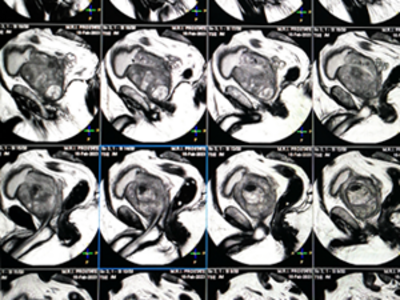 MRI image of an enlarged prostate.