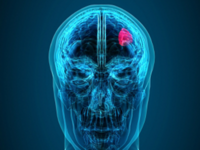 X-Ray scan of a human displaying a tumor in the brain.