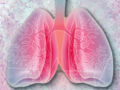 Artist illustration of lungs set against a background of a stained pathology slide.