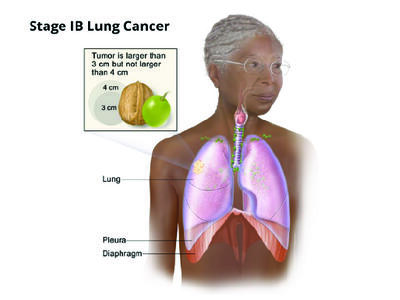An illustration of stage 1B lung cancer