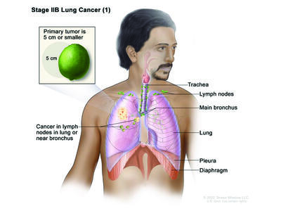 An anatomic illustration of stage 2b nonsmall cell lung cancer