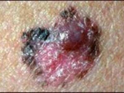 A close-up photo of melanoma on otherwise health skin. The area of the melanoma is black and mostly reddish-pink; a small mole-sized growth, purplish red, sit on top of the top right of the melanoma area.