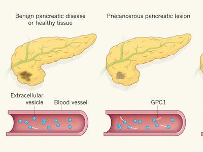 Three illustrations of the pancreas, ranging from benign diseases to precancerous lesion to pancreatic cancer. The cancer is shown as brown discoloration for the benign disease, growing to actual tumor cells on the right. Below each illustration, extracellular vesicles in the blood vessel gains more GPC1 as the pancreas gets more cancerous.