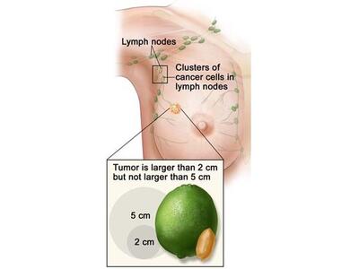 Illustration of breast cancer, labeling lymph nodes and clusters of cancer cells in lymph nodes. An inset coming from a tumor in the illustration reads: Tumor is larger than 2 cm but not larger than 5 cm. An inset compares the size to a lime and a peanut.