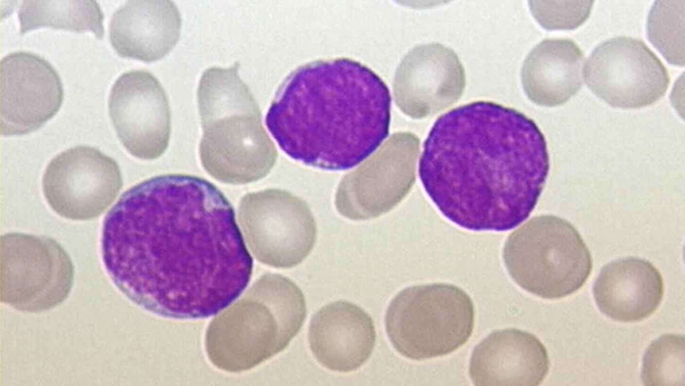 Microscope image of blood cells showing normal red blood cells alongside three larger, purple-stained white blood cells (lymphocytes).
