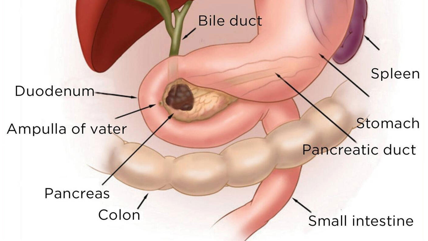 Illustration of a pancreatic tumor.