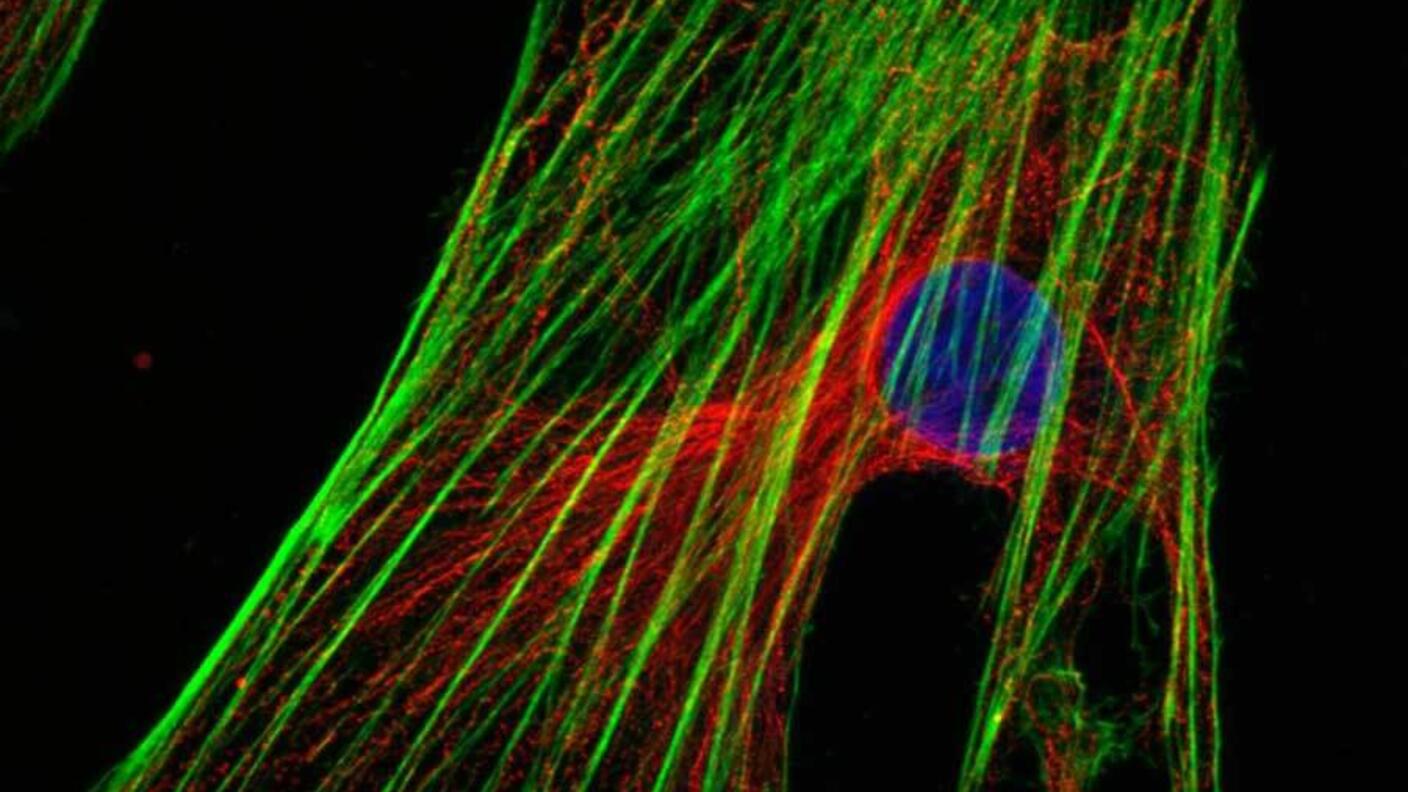 Metastatic cervical cancer cells
