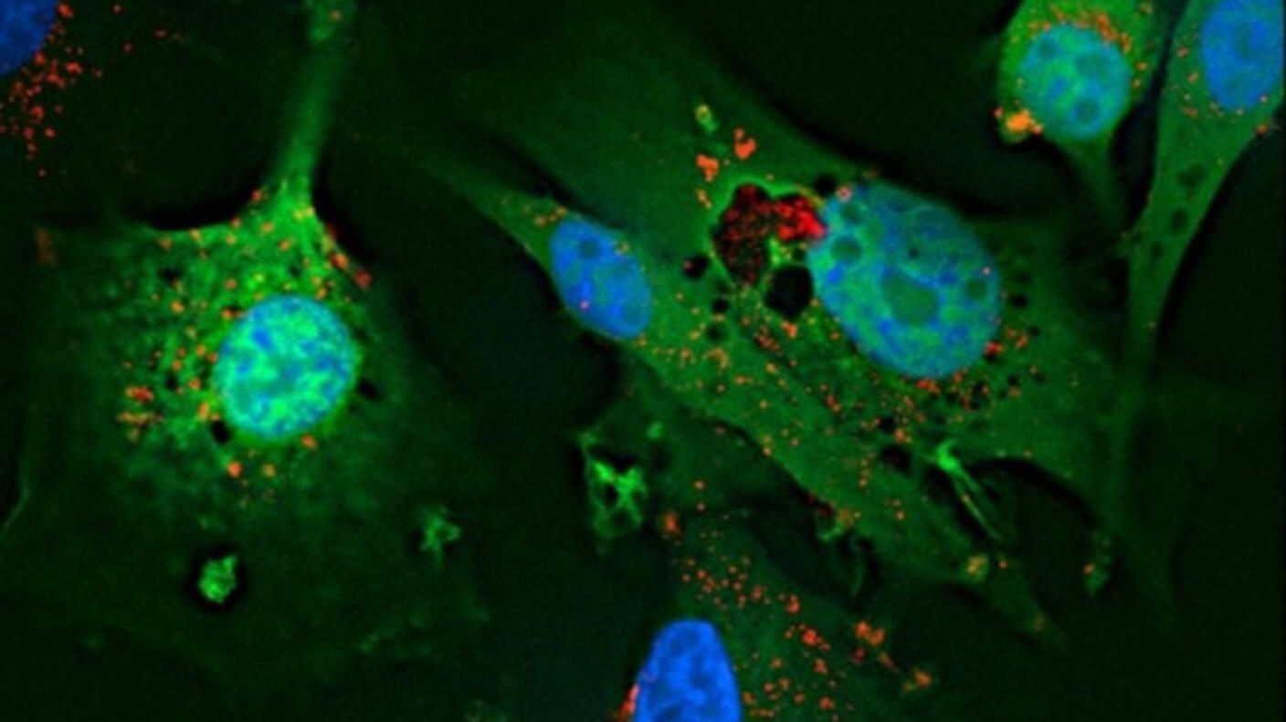 Microscopic image of glioblastoma cells in culture. Various shapes of green fading into black have small areas of light green and blue on top of them. Very small orange and red dots can also be seen.