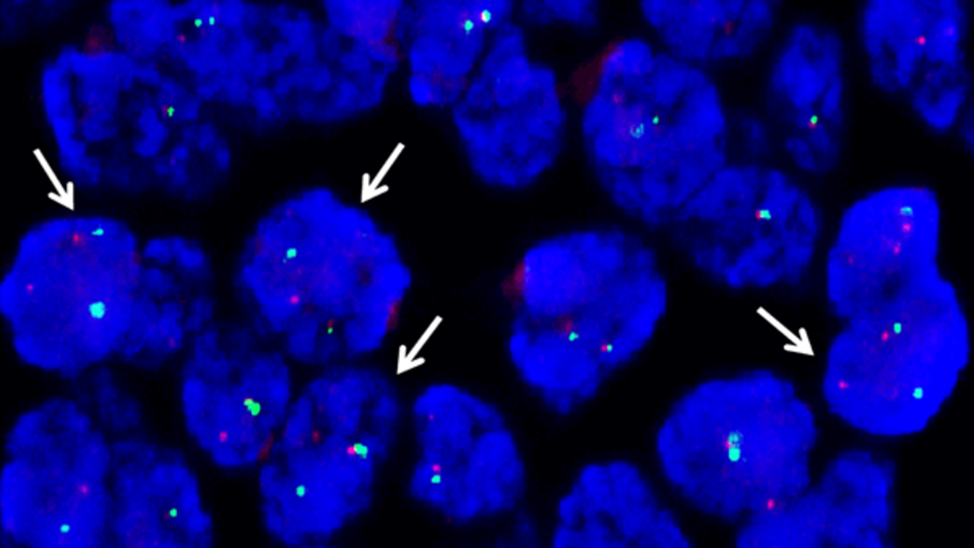 Microscopic view of Ewing sarcoma cells with arrows indicating gene fusions involving the EWS gene.