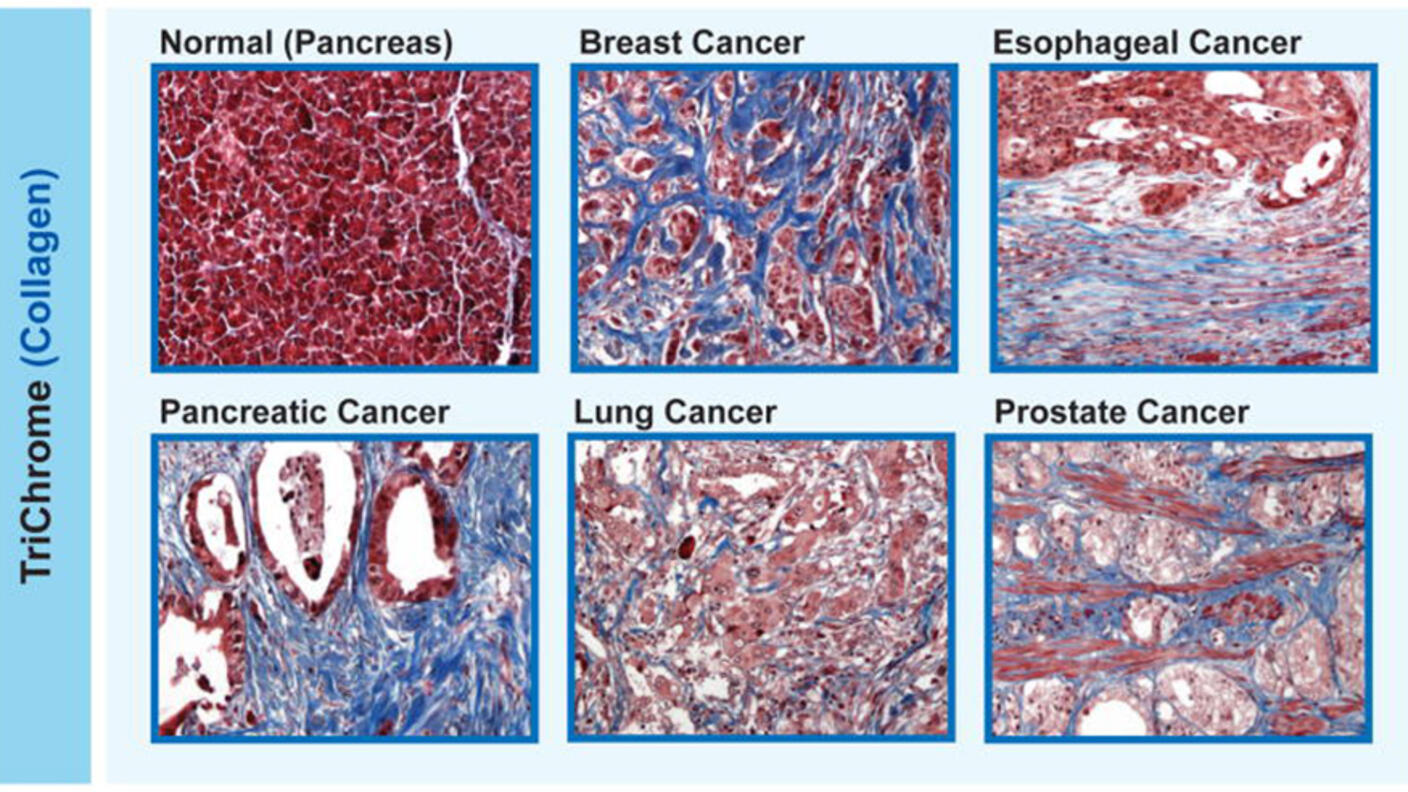 Six histological slides stained with Masson's trichrome to highlight collagen in tissues. Each slide represents a different condition: normal pancreas tissue, breast cancer, esophageal cancer, pancreatic cancer, lung cancer, and prostate cancer. The slides show varying patterns of red (indicating muscle and keratin), blue (indicating collagen), and white spaces (indicating cellular and glandular structures), offering visual insights into the structural differences between healthy and cancerous tissues.