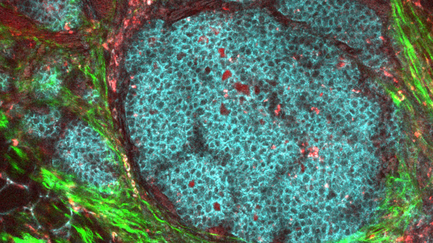 Microscopic view of a breast cancer tumor