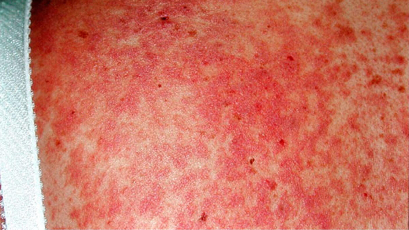 Close-up of skin showing a bright red, blotchy rash across the torso, characteristic of chronic graft-versus-host disease symptoms.