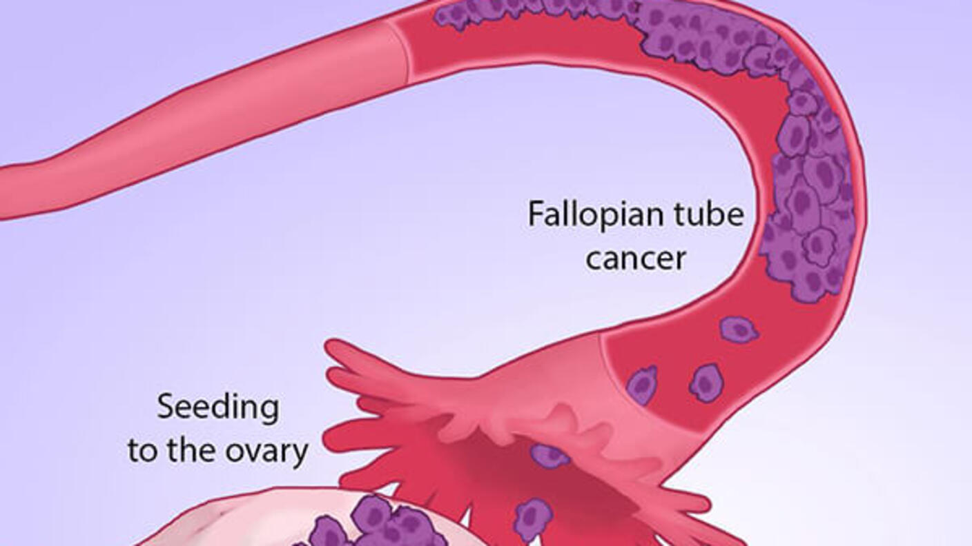Microscopic view of Ewing sarcoma cells with arrows indicating gene fusions involving the EWS gene.