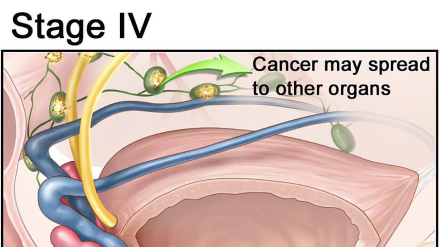 Illustration showing a close-up of the prostate and cancer spreading to other organs, with cancerous areas and lymph nodes highlighted. An arrow indicates the ability for the cancer to spread.