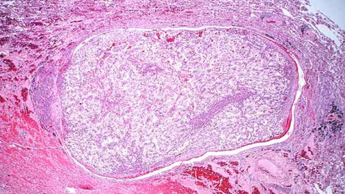 Microscopic pathology slide showing cross-sectional tissue from a kidney tumor, stained pink with distinct cellular patterns and structures visible under magnification.