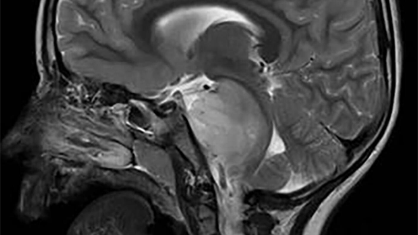 Brain scan showing a DIPG tumor in the brainstem of a child.