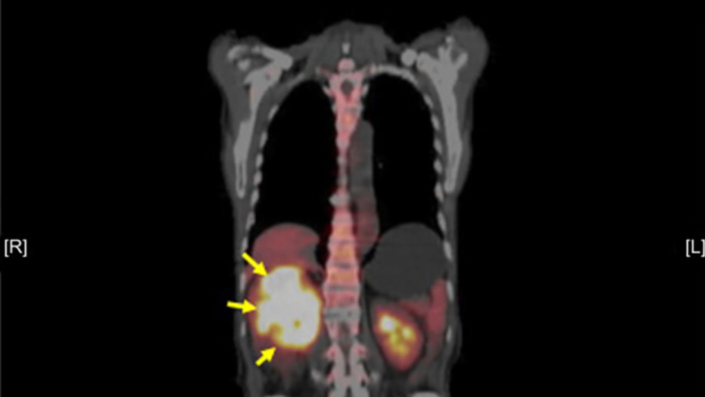 Medical PET scan showing a tumor in the right kidney, highlighted with yellow arrows pointing to the bright yellow-white areas indicating areas of increased metabolic activity typical of cancerous tissue.