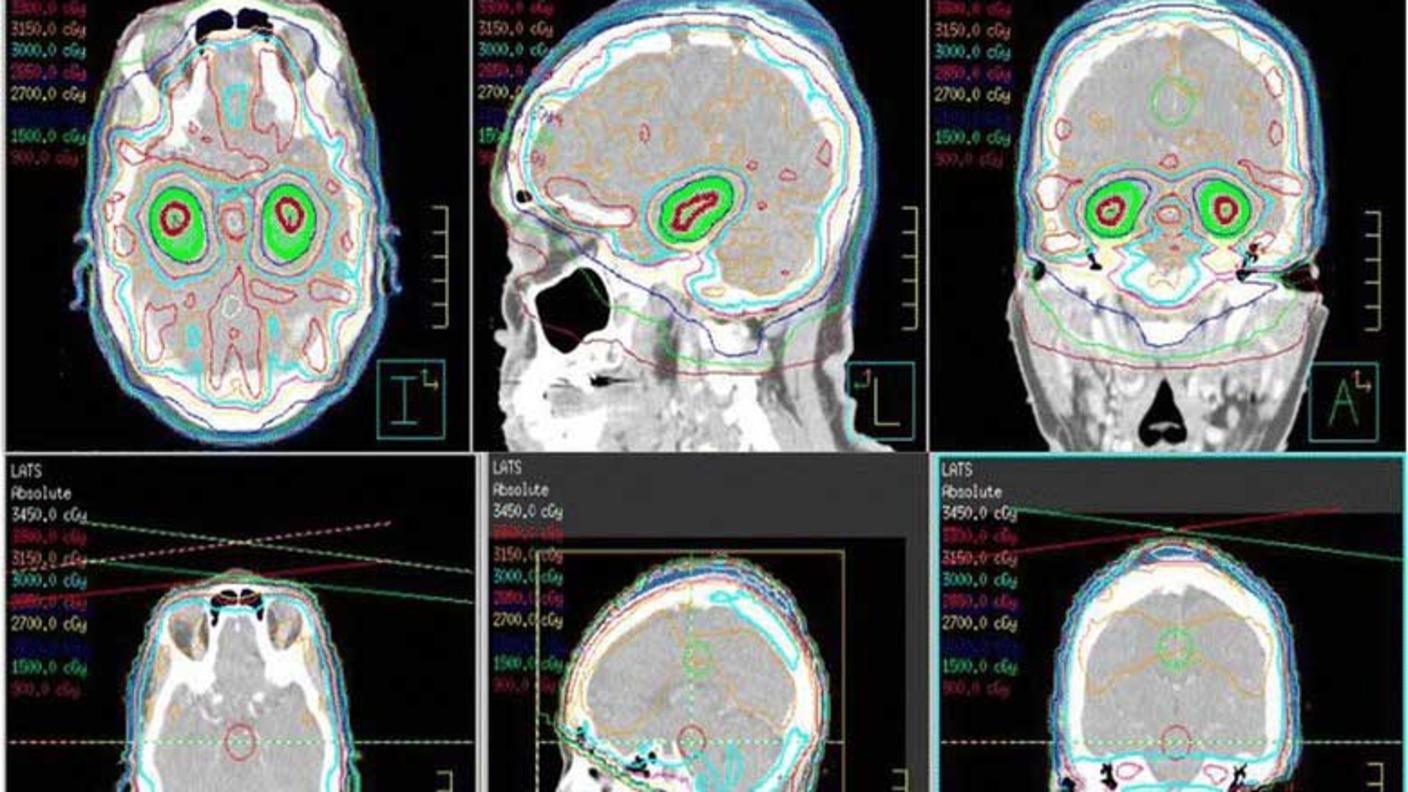 An image comparing whole brain radiation therapy that avoids the hippocampus with standard whole brain radiation therapy.