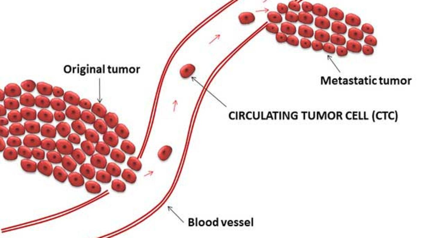 Diagram showing how circulating tumor cells (CTCs) break away from the original tumor, travel through the bloodstream, and form a metastatic tumor in another location.