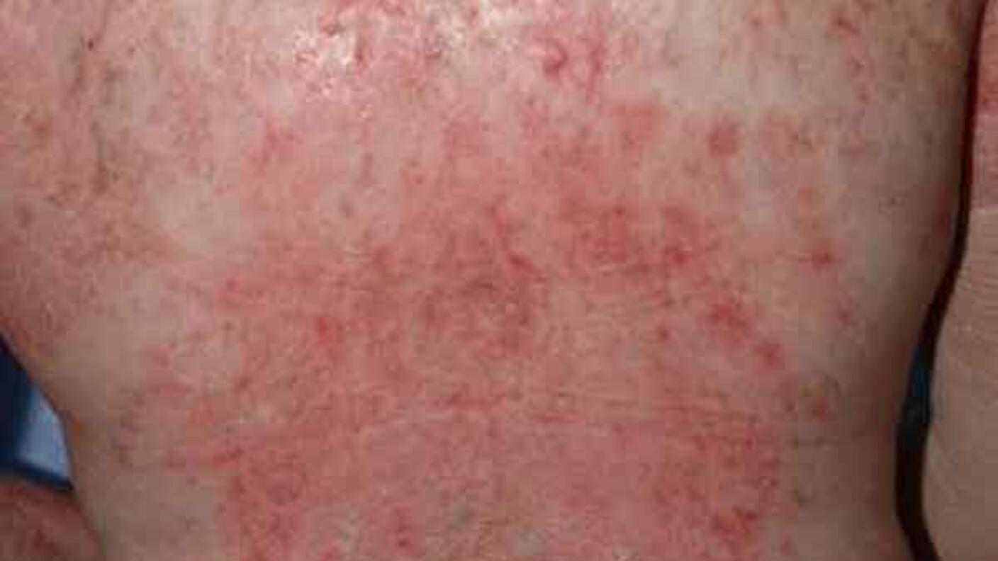 Close-up of back showing reddish, mottled skin changes characteristic of chronic graft-versus-host disease, with areas of inflammation and altered pigmentation.