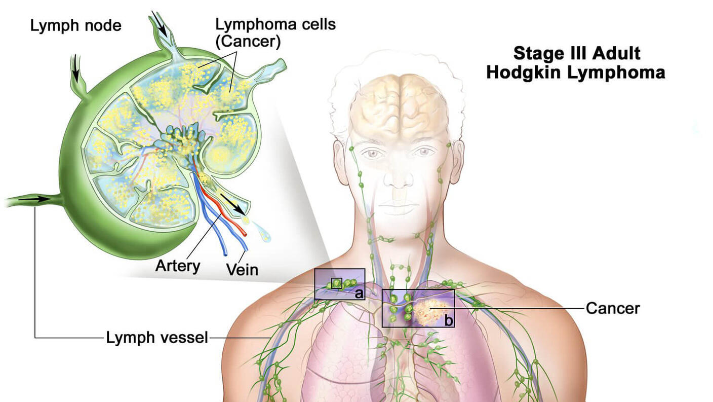 Illustration of Stage III Adult Hodgkin Lymphoma. The image shows the human body with a focus on the lymphatic system. Lymph nodes, vessels, the diaphragm, and spleen are highlighted. Cancerous lymphoma cells are present in lymph nodes above and below the diaphragm. An inset on the left provides a close-up of a lymph node, showing lymphoma cells, arteries, and veins.
