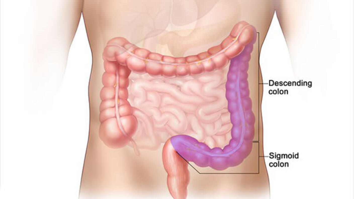 Two side-by-side illustrations about the colon. The top section, labeled "Proximal Colon," highlights the ascending colon, cecum, and transverse colon in purple on the left side of the body. The bottom section, labeled "Distal Colon," shows the descending colon and sigmoid colon in purple on the right side of the body. The colon is depicted within an outline of the human torso, showing its position relative to other internal organs.