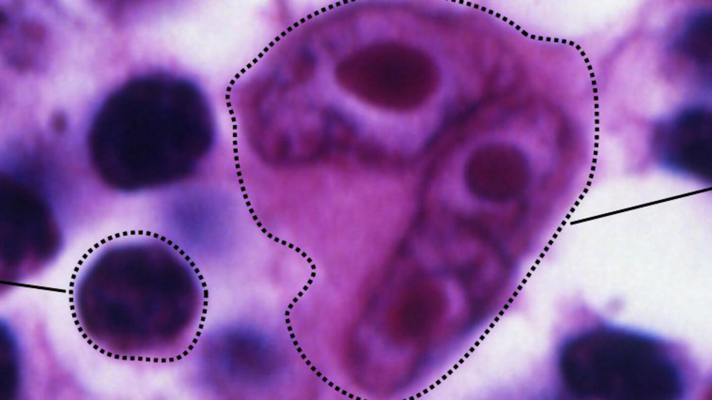 A comparison of normal lymphocytes alongside a Reed-Sternberg Cell. The lymphocyte is a dark purple circle; there are a number of these on a purple and white background. The Reed-Sternberg Cell is a medium-purple, approximately five to six times as large as the lymphocyte, and has three nuclei. 
