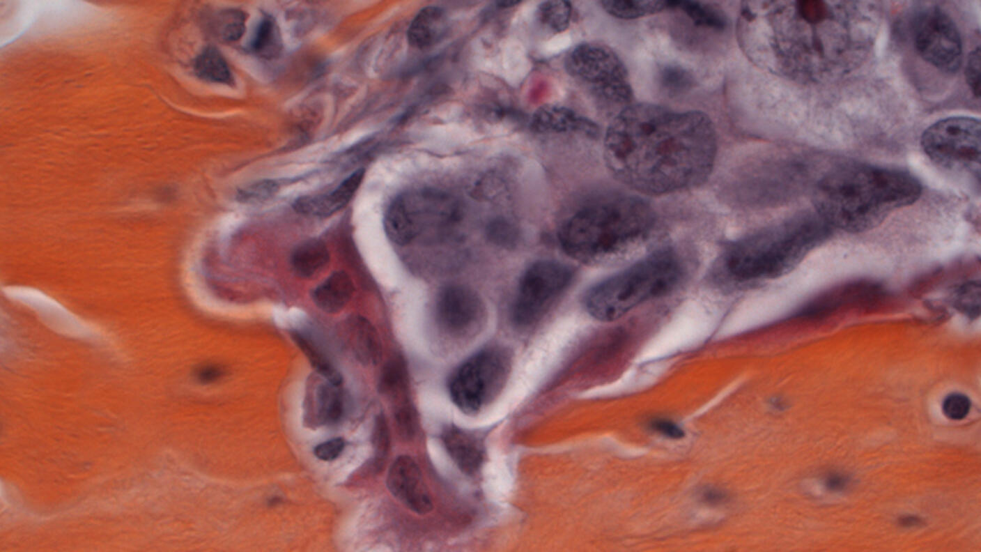 Microscopic image showing cancer cells (purple) with bone tissue (orange) and osteoclasts (red) that break down bone during metastasis, illustrating how cancer spreads to bone.