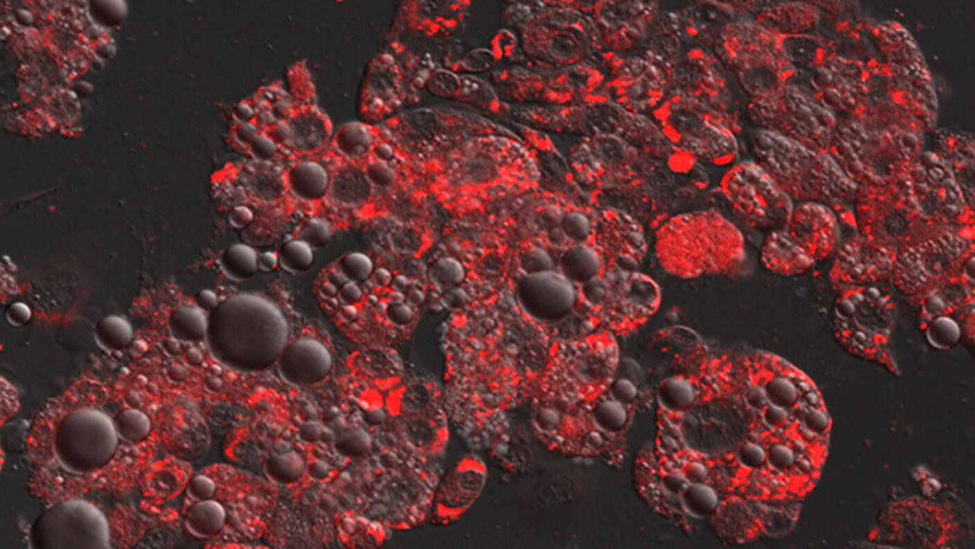 Microscopic image showing fat cells absorbing the chemotherapy drug daunorubicin, potentially reducing its effectiveness.