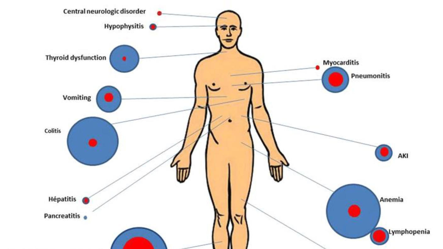 Illustration of a human figure annotated with various medical conditions, each represented by differently sized circles. Larger circles indicate common conditions, and smaller ones indicate rarer issues. Conditions include central neurologic disorder, hypothyroidism, myocarditis, pneumonitis, colitis, hepatitis, pancreatitis, AKI (acute kidney injury), anemia, lymphopenia, and skin-related issues. Lines connect each condition to specific body areas.