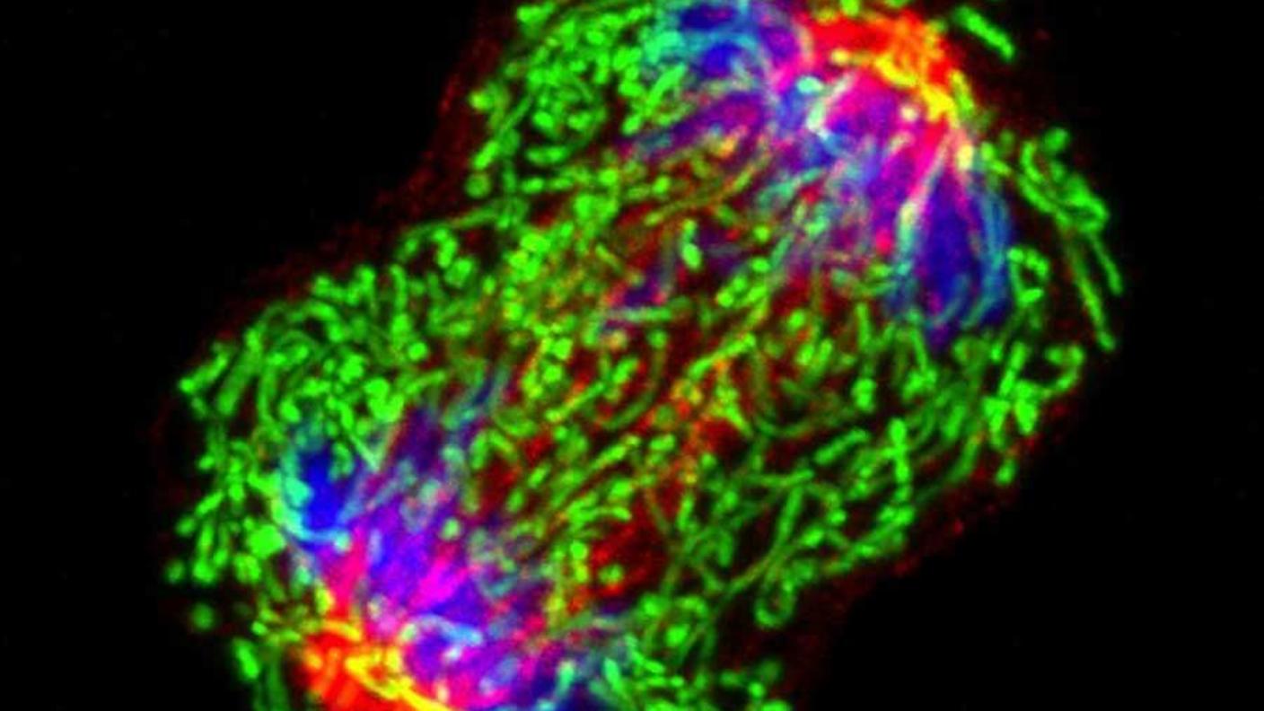Breast cancer cell undergoing cell division.