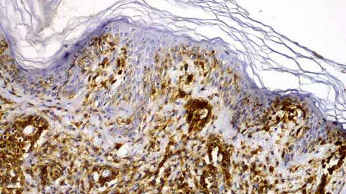 Microscopic tissue image showing CD30+ cutaneous anaplastic large cell lymphoma (ALCL) with distinctive brown-stained abnormal cells throughout the tissue sample.