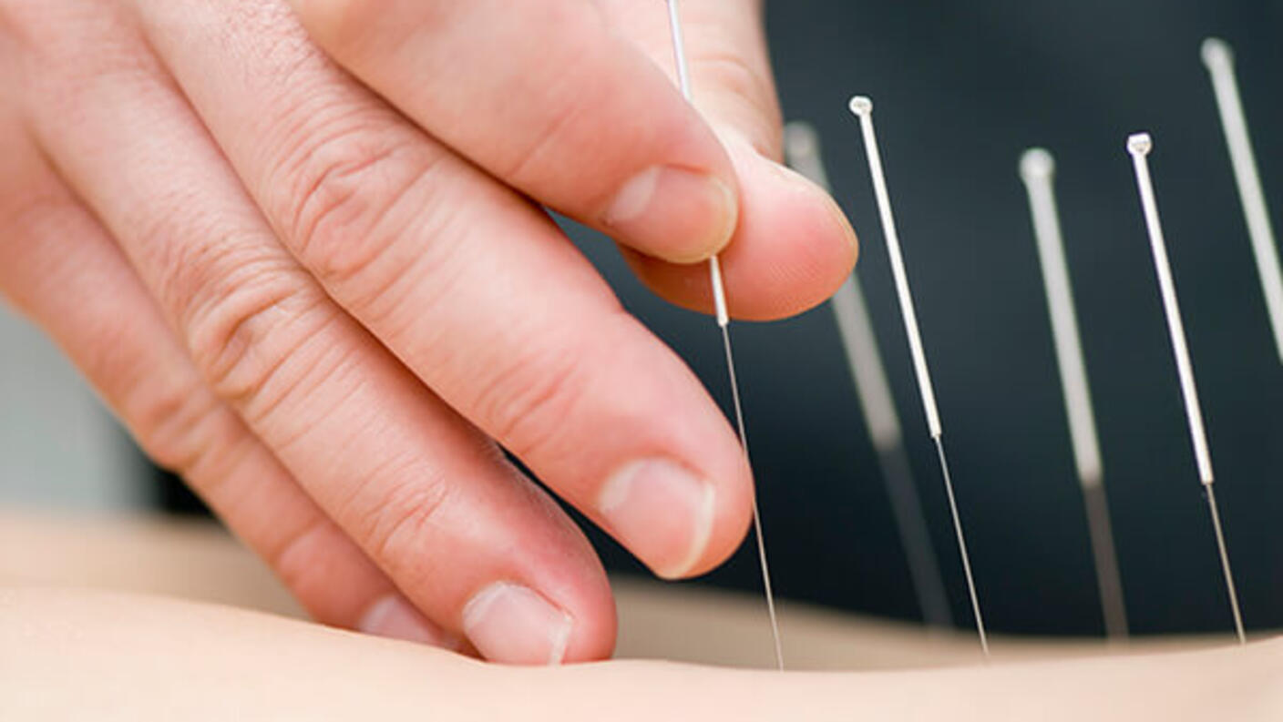 Close-up of acupuncture treatment showing several thin needles inserted into a patient's body, with a practitioner's hand positioned nearby for guidance.