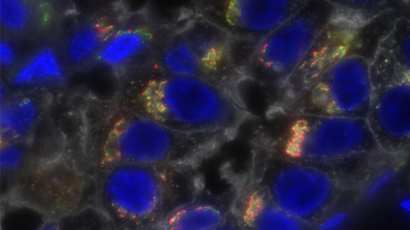 Triple-negative breast cancer cells stained to show profound molecular heterogeneity.