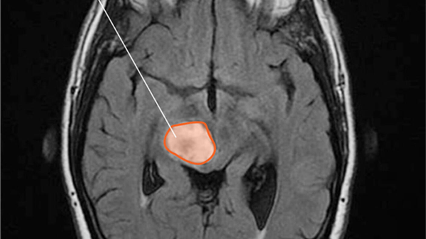 MRI of a midline glioma.