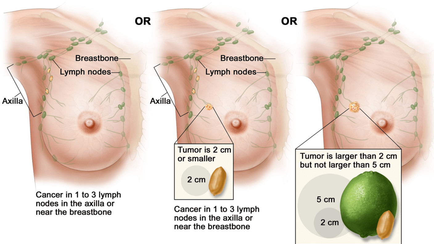 Illustration of Stage IIA Breast Cancer showing three scenarios. The left panel: Cancer is present in 1 to 3 lymph nodes in the axilla or near the breastbone, with no visible tumor in the breast. The middle panel: Tumor is 2 cm or smaller, with cancer in 1 to 3 lymph nodes in the axilla or near the breastbone. An inset shows the size comparison with a peanut. The right panel: Tumor is larger than 2 cm but not larger than 5 cm. An inset compares the size to a lime and a peanut.