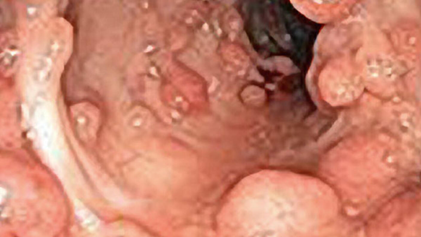 An endoscopic view of polyps. The polyps are of various sizes, mostly dome-shaped, around all sides of what appears to be a pink tunnel. 