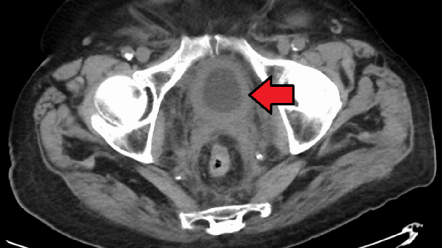 CT scan bladder cancer thickening of the bladder wall