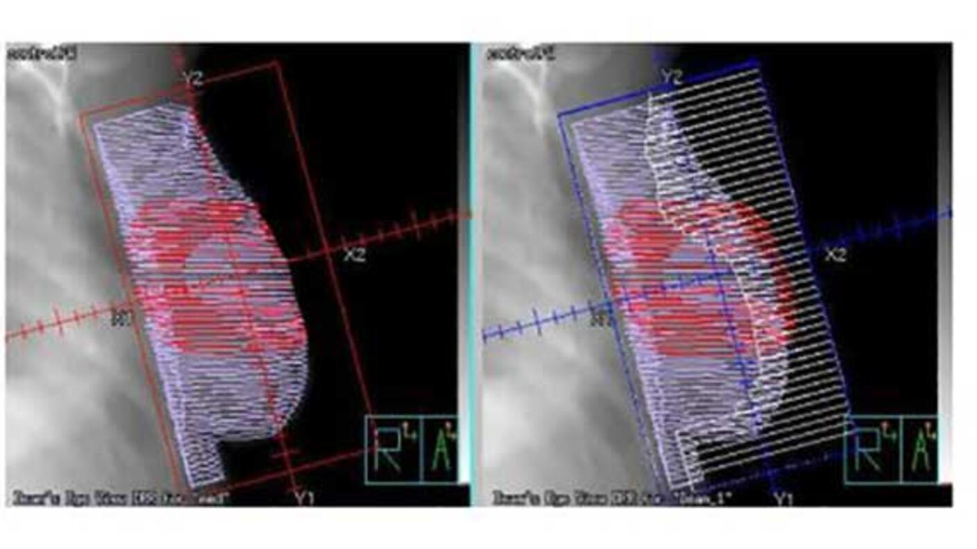 Side-by-side medical imaging scans showing breast radiation therapy planning with highlighted treatment areas and dose grids.