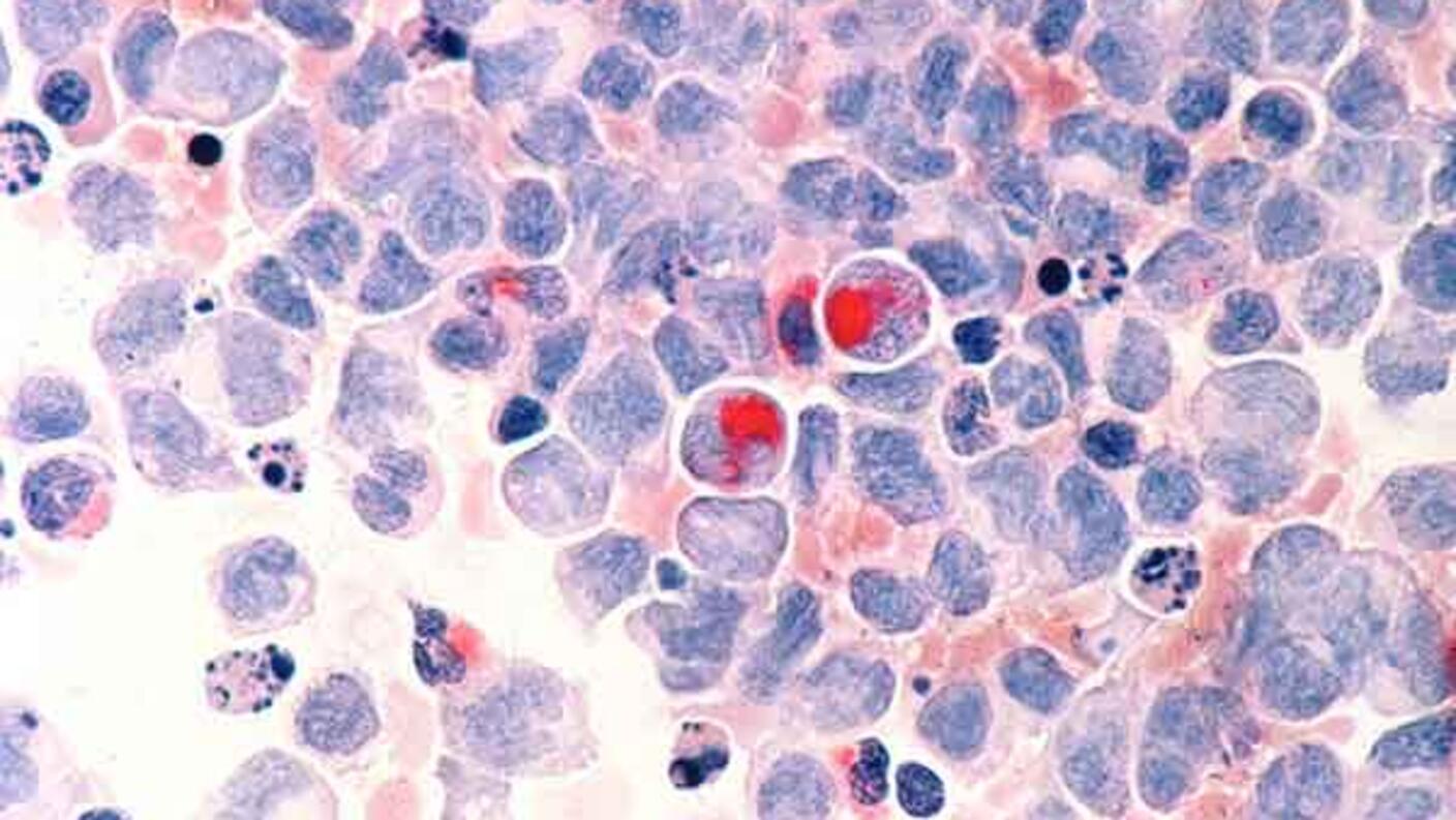 Human cells with acute myelocytic leukemia as seen through a microscope