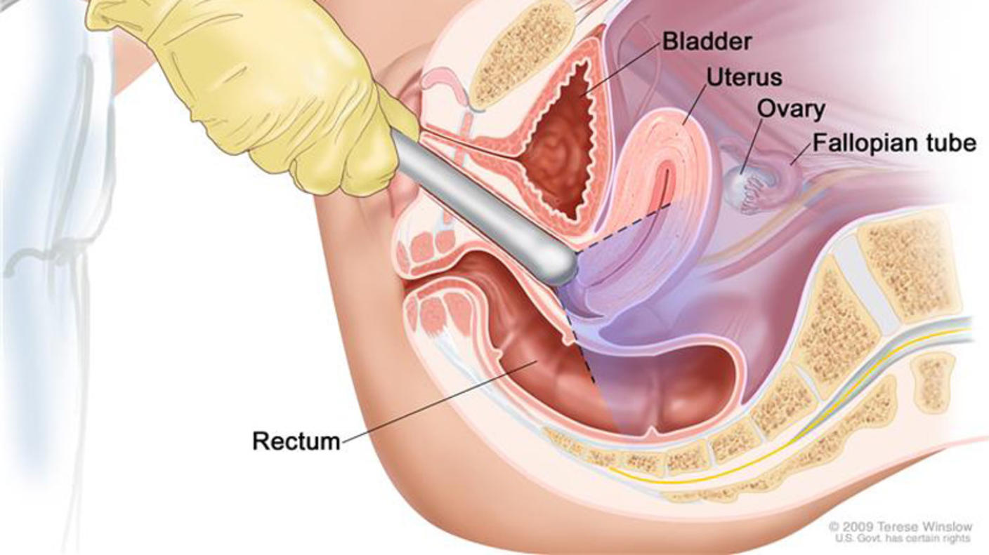 An illustrated cross-section titled “Transvaginal Ultrasound.” In the top right corner is a small illustration in which a nurse holds a transducer inside of a patient who is lying on her back, while the nurse looks at a computer screen with the ultrasound image. The larger cross section shows the transducer around surrounding anatomy, labeling the bladder, uterus, ovary, fallopian tube, and rectum. 
