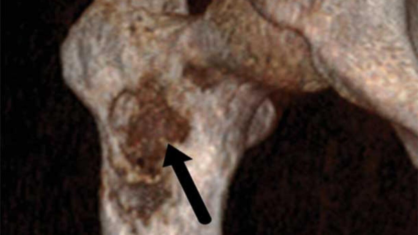 CT scan of a femur with cancer.