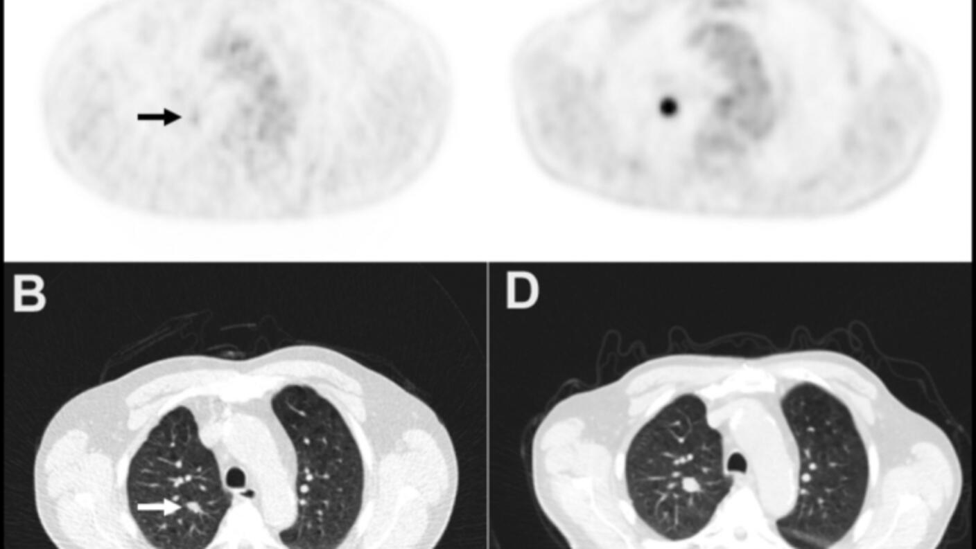 Imaging scans showing a lung nodule in panels A and B that enlarged over 11 months (panels C and D) and later confirmed as lung cancer via biopsy.
