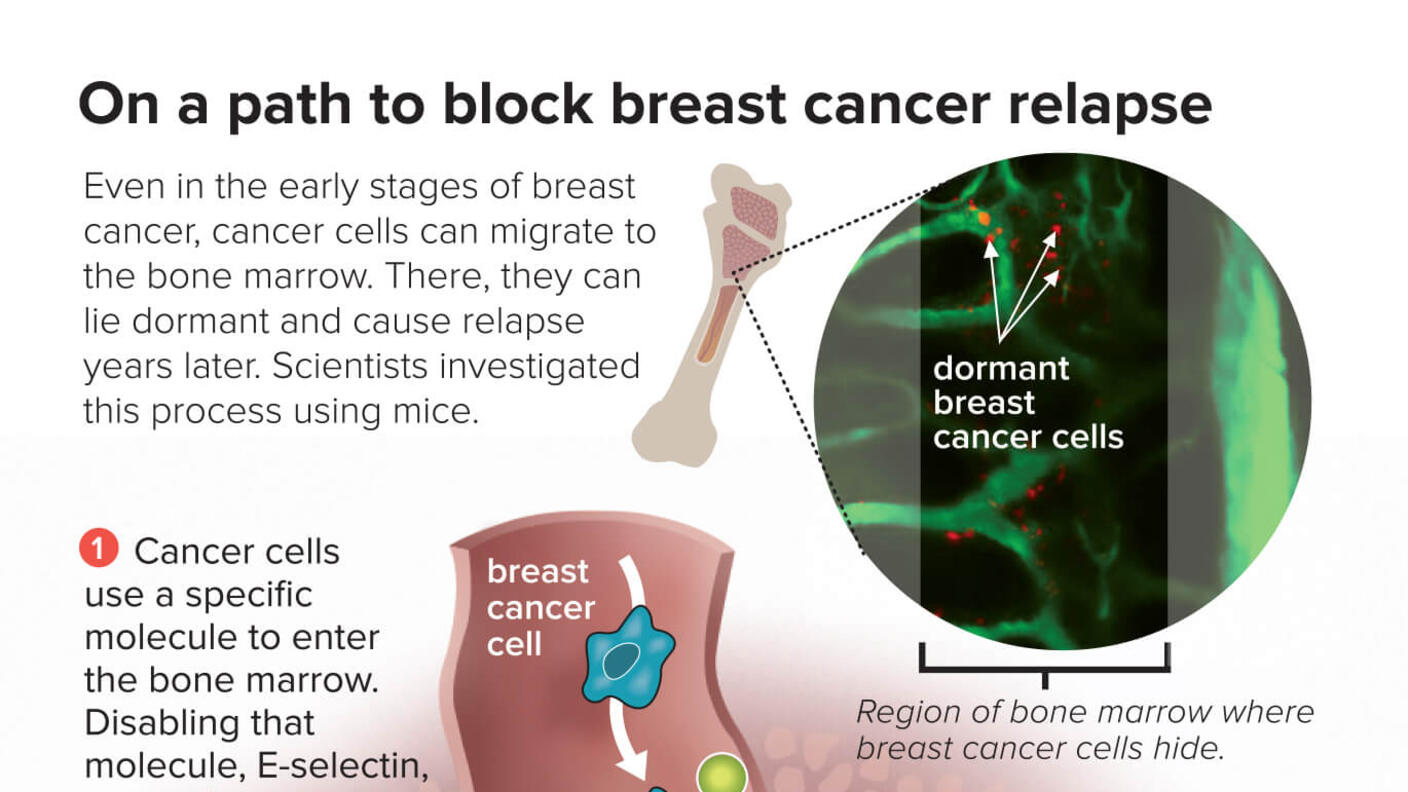 An infographic titled “On a path to block breast cancer relapse”. At top, a bone illustration emits an inset that shows dormant breast cancer cells inside of bone marrow. Below, a three-part diagram shows cancer cells entering bone marrow using the molecule E-selectin, a molecule anchoring the cancer cell, and a drug (plerixafor) ejecting the cells from the marrow.