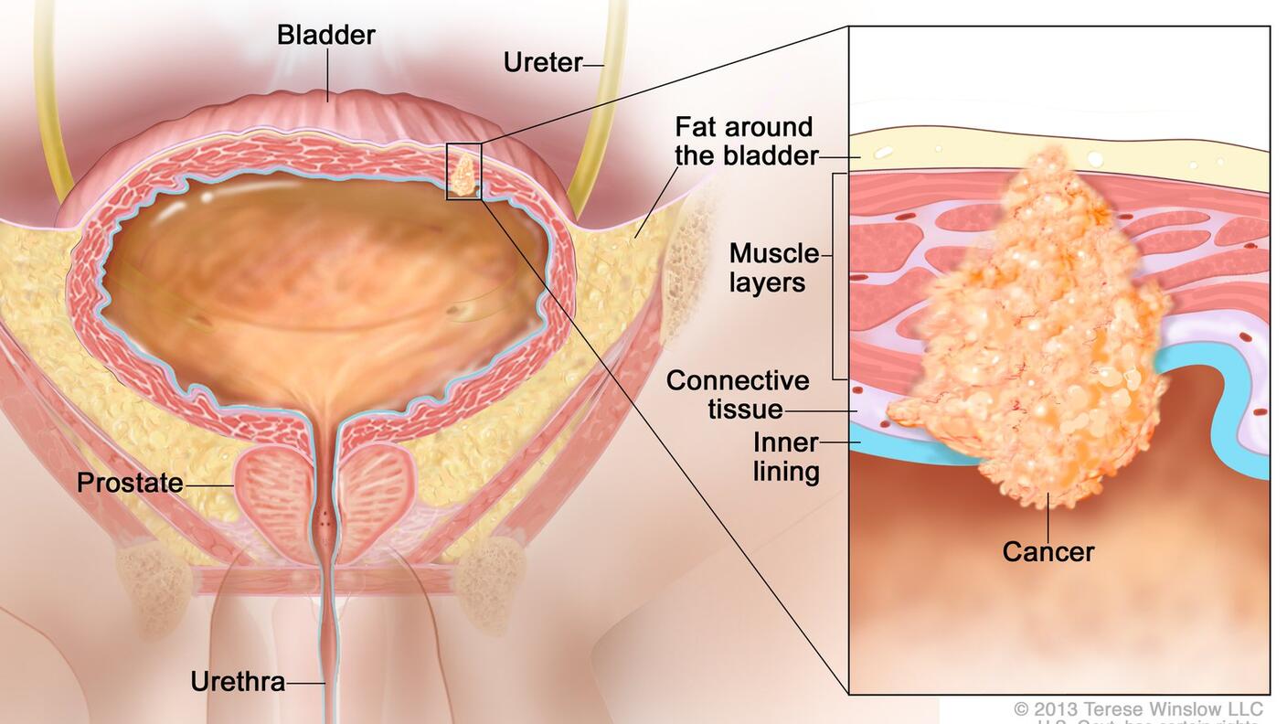 Illustration labeled “Stage III Bladder Cancer.” The main illustration labels the bladder, ureter, fat around the bladder, urethra, and prostate. A small cancer cluster inside of the muscle and fat layers of the bladder is linked to an inset illustration which labels the muscle layers, connective tissue, and inner lining of the bladder along with the actual cancer. 