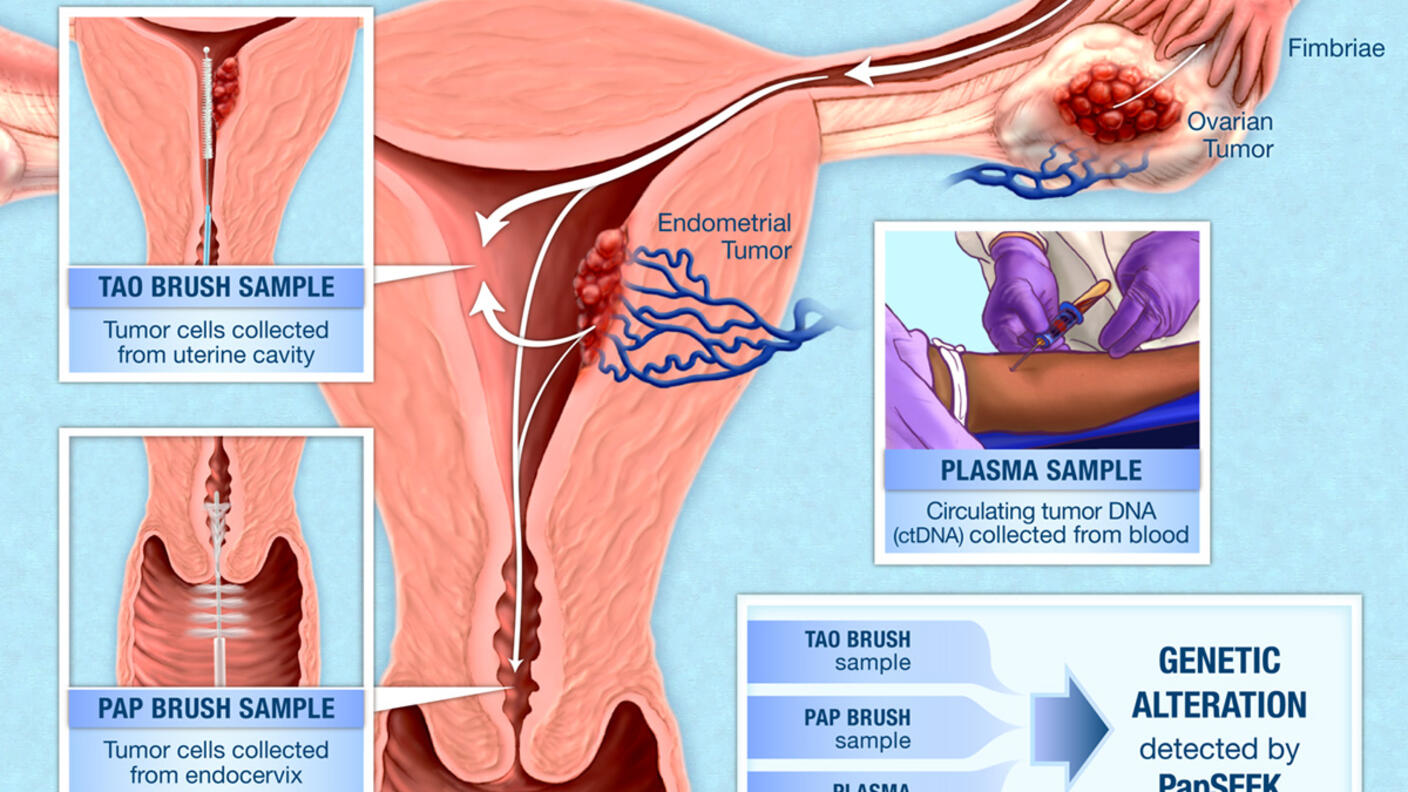 Illustration of how PapSEEK detects genetic alterations in endometrial and ovarian cancers using samples from Tao brush, Pap brush, and blood plasma.