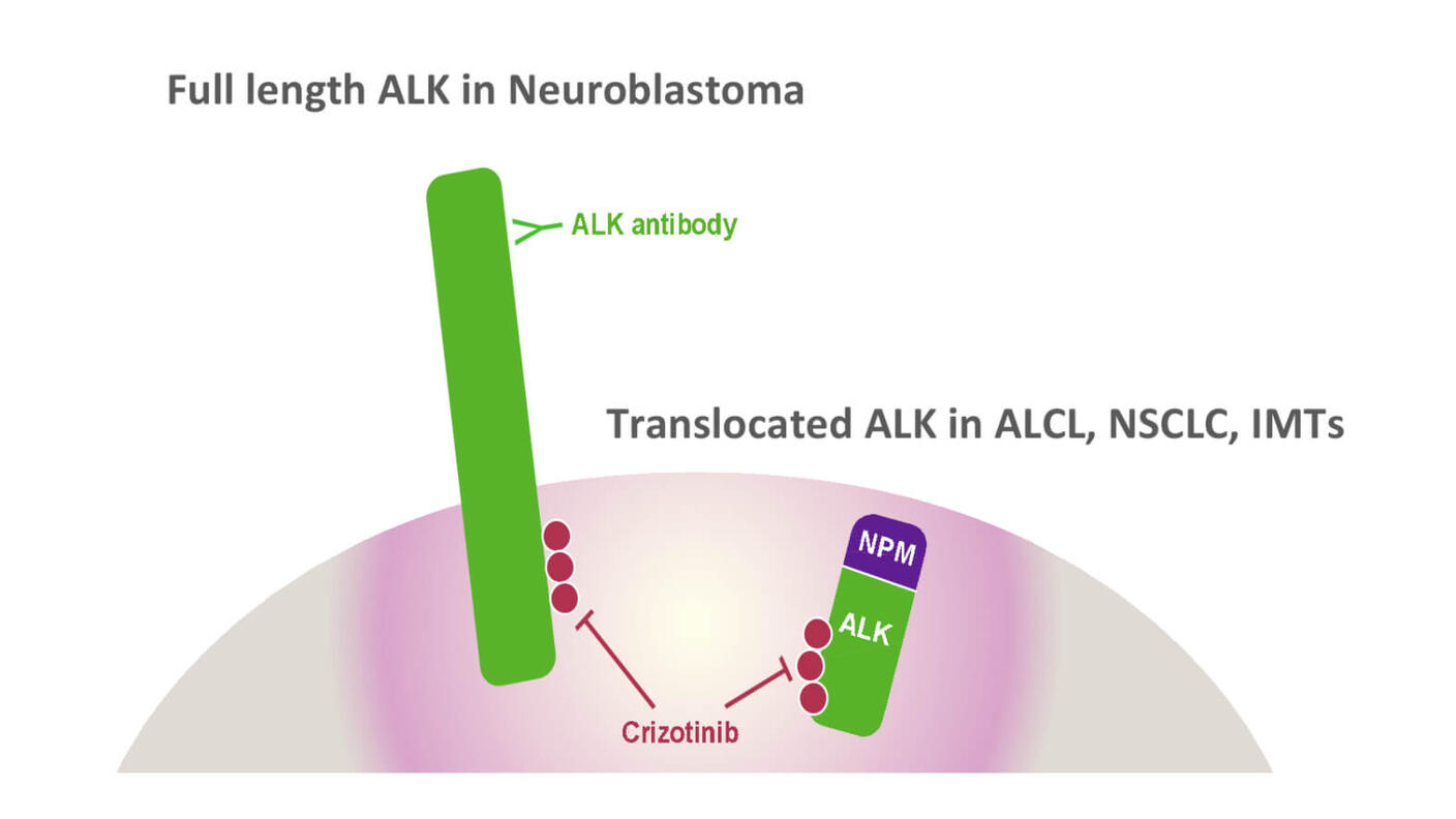 Diagram showing full-length ALK in neuroblastoma targeted by an antibody, and translocated ALK in ALCL, NSCLC, and IMTs inhibited by Crizotinib.