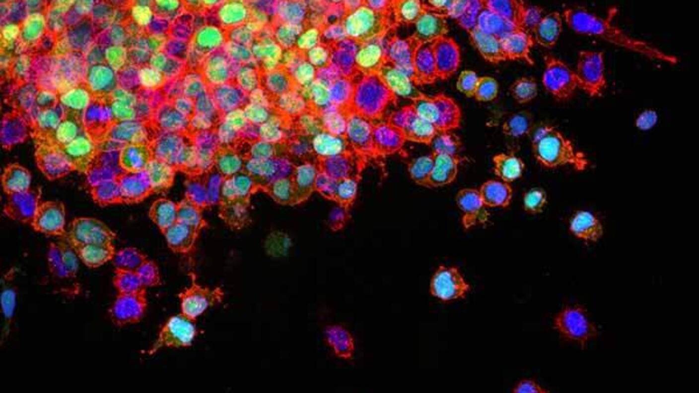 A lab model of metastasizing non-small cell lung cancer cells. FDA recently approved the targeted therapy brigatinib for some patients with metastatic lung cancer.